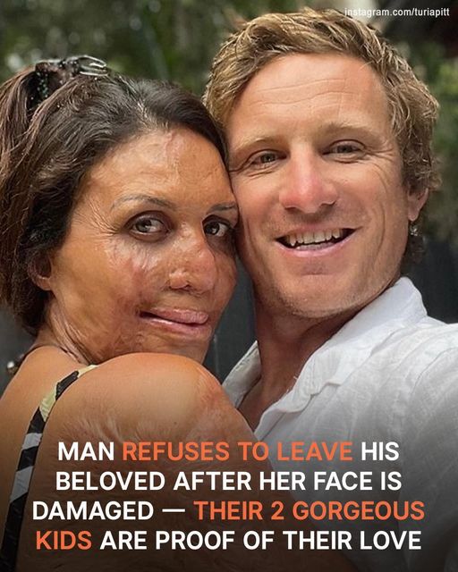 Man Refuses to Leave His Beloved despite Her Damaged Looks & Marries Her – They Welcome 2 Cute Kids