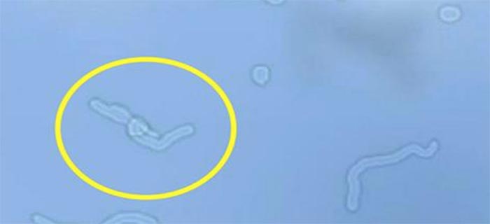 I Always Wondered Why I Had These Floating In My Eye..Then A Doctor Told Me What They Are