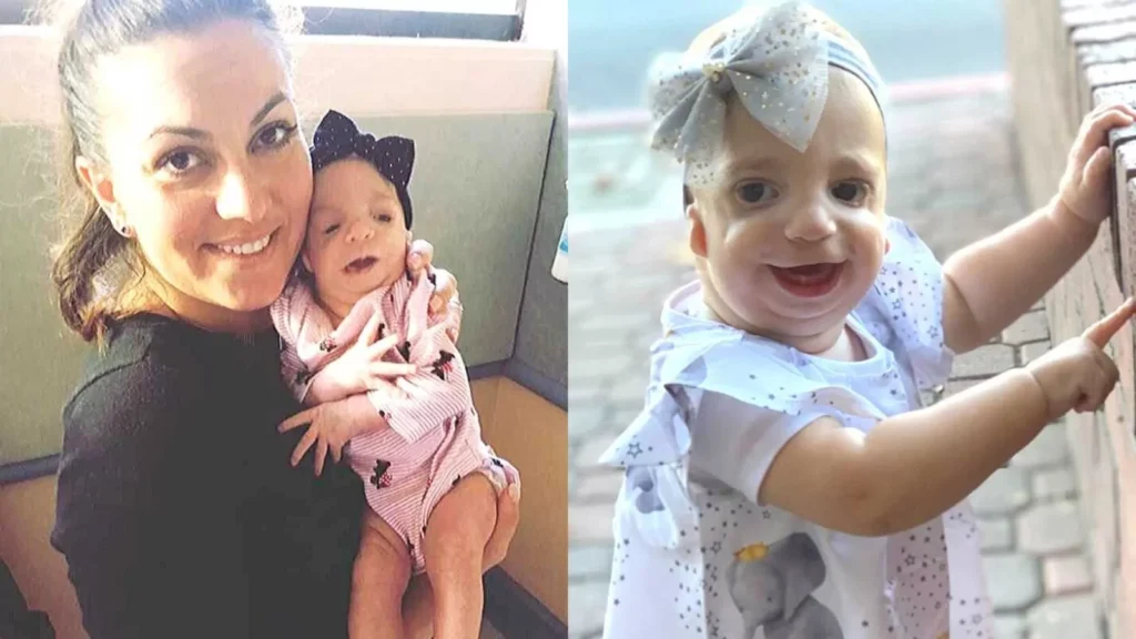 Mom shares touching story of raising a daughter with Treacher Collins Syndrome