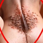 The Hidden Dangers of Ignoring Fungal Infections
