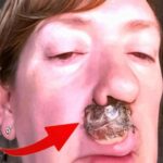 Body Acne: 4 Tips To Get Rid Of Them